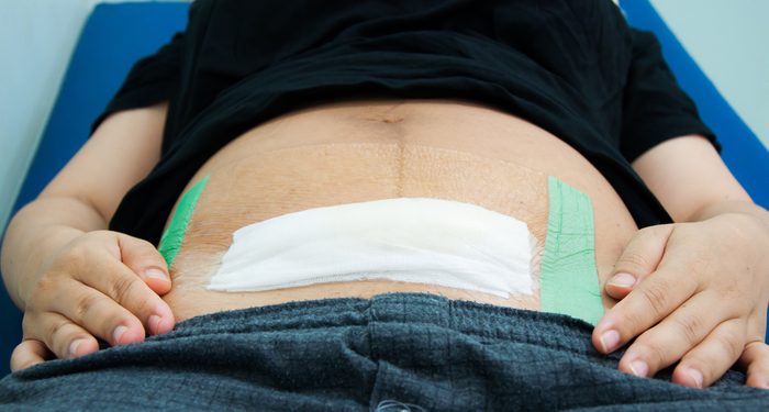 Close gauze on Cesarean Section wound. abdominal