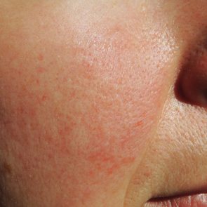 Rosacea on face of middle aged woman