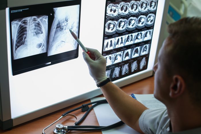 doctor looking at copd lungs on X-ray