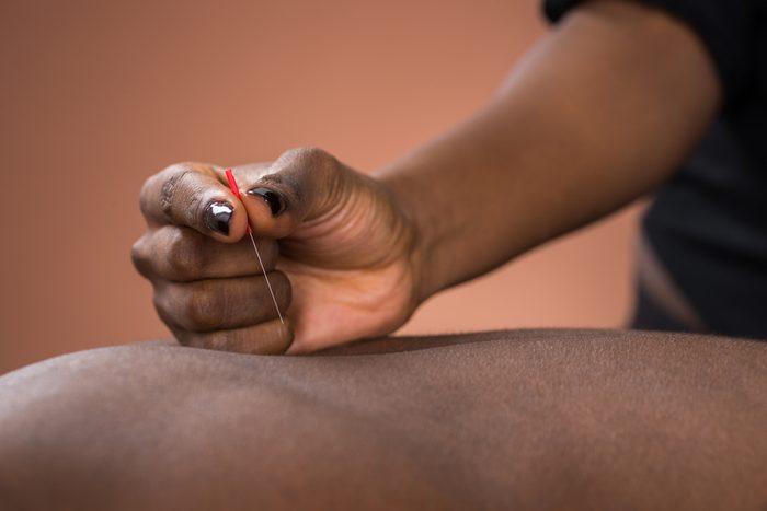 Young African Man Getting Acupuncture Treatment In Spa