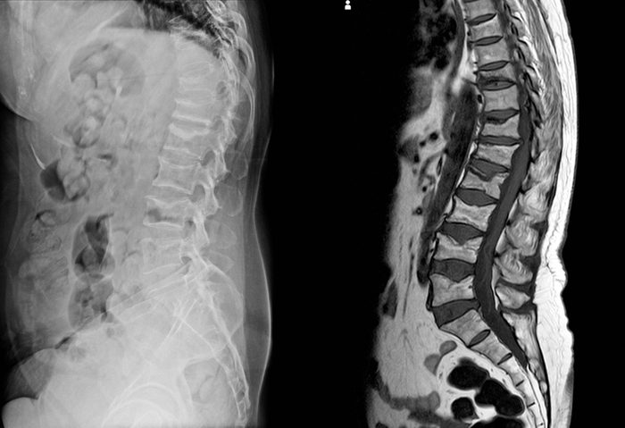 X-ray and MRI Lumbar spine findings severe vertebral collapse of T12 vertebra mild to moderate collapse of L1-2 vertebrae.