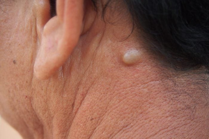 Person's neck with a sebaceous cyst.