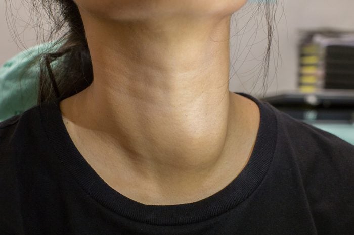 Neck of a woman in black shirt with enlarged thyroid gland.