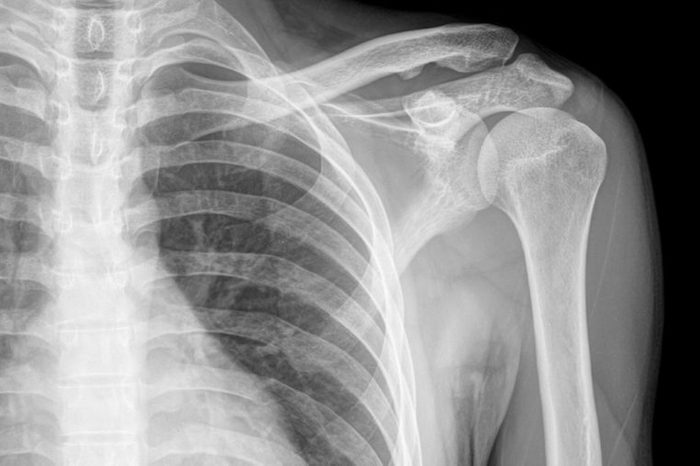 Regular shoulder on x-ray image.