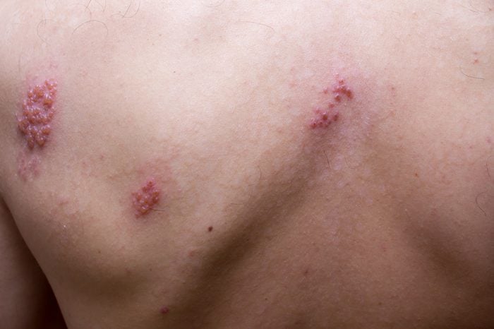 Shingles (herpes zoster) on a man's back.