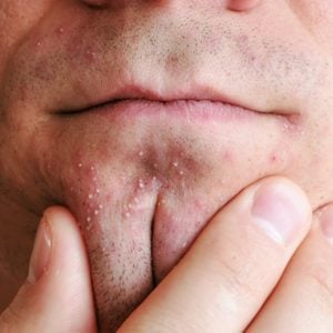 Skin irritation after shaving. Man's hands squeeze pimples on the chin. Closeup chin, lips.
