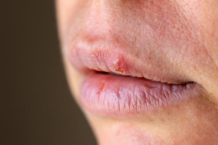 woman's cracked lips