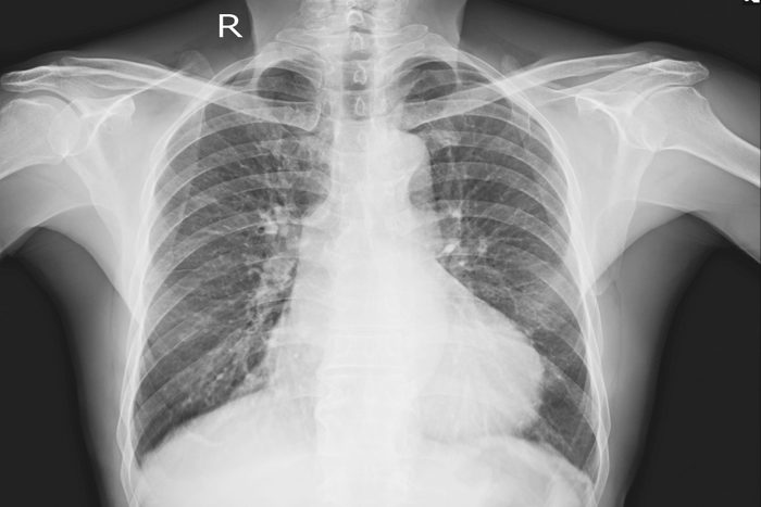 X-ray Chest Upright A Male 76 year old Fine Cardiomegaly.No definite active lung infiltration or lung mass.No pleural effusion.