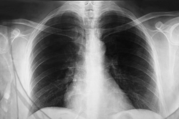 Close up a chest xray