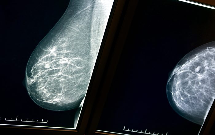 X-ray mammogram image of breast with cancer