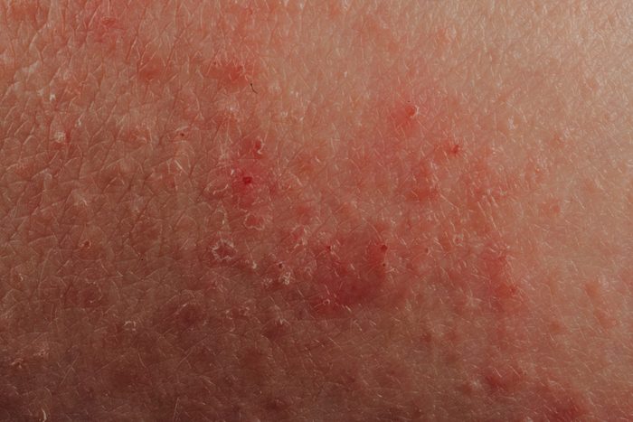 skin rash close up