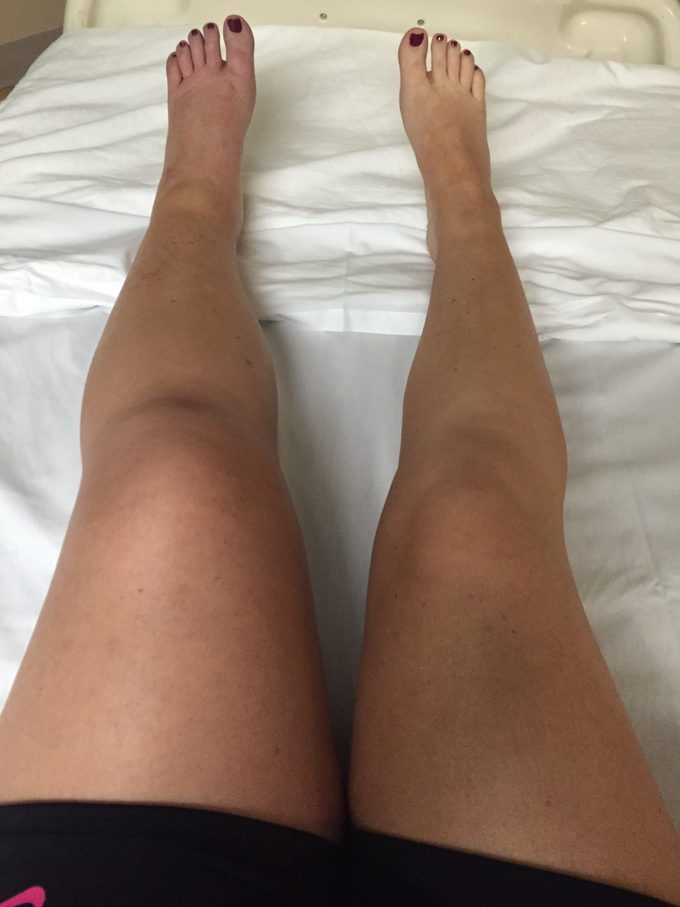 swollen legs