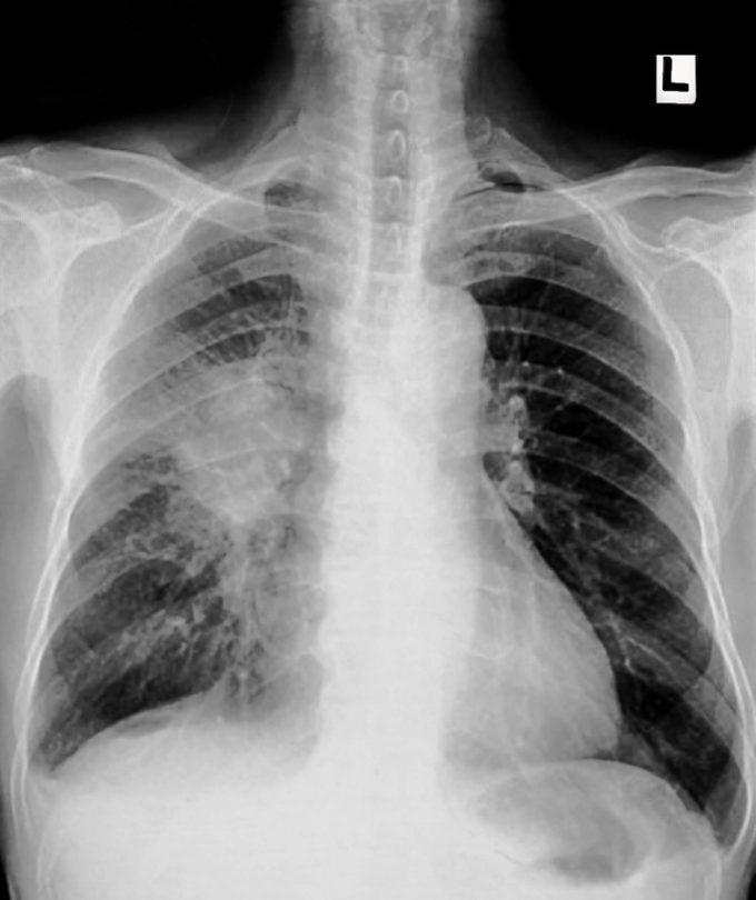 Lung cancer, pleural effusion