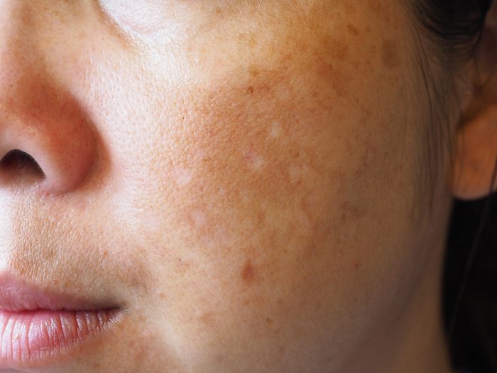 woman's cheek with skin issues