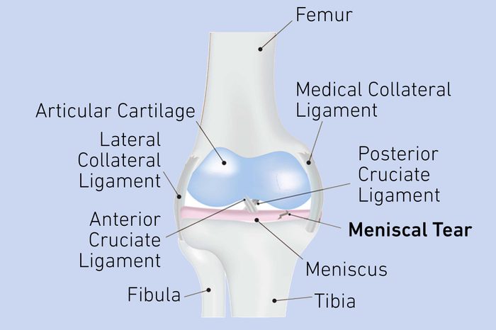 Image of a knee joint with a meniscus tear.