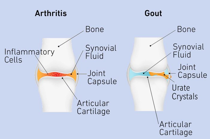 arthritis and gout pain behind knee diagram