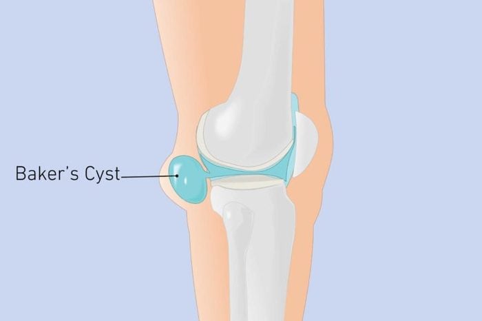 Illustration of a knee joint with baker's cyst.