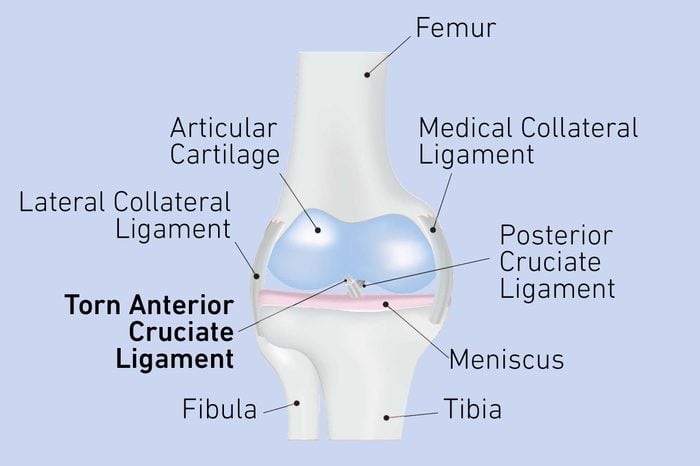 Illustration from a knee joint with a torn ACL.