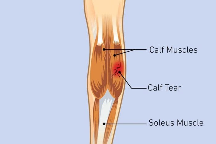 Illustration of a knee joint with a calf strain.