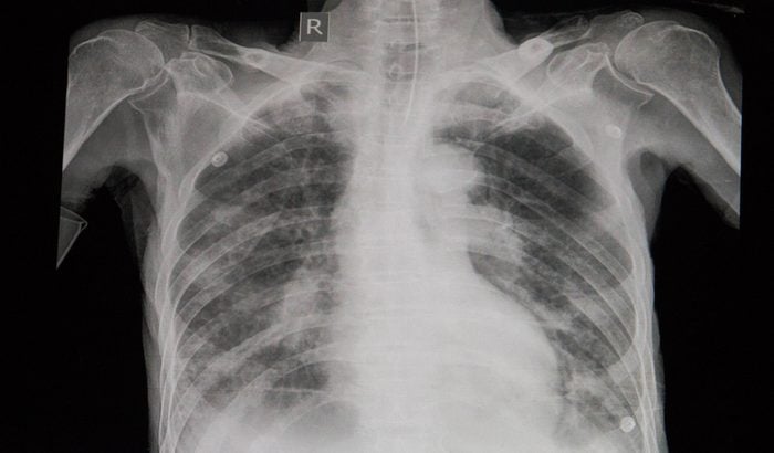 diagnostic chest X-ray film of a patient with cardiomegaly, pulmonary edema