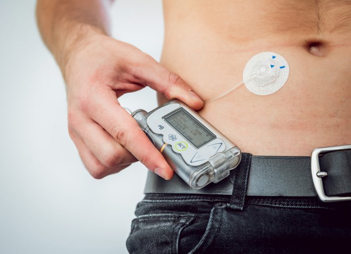 Diabetic man with an insulin pump connected in his abdomen and keeping the insulin pump on his belt. Diabetes concept.