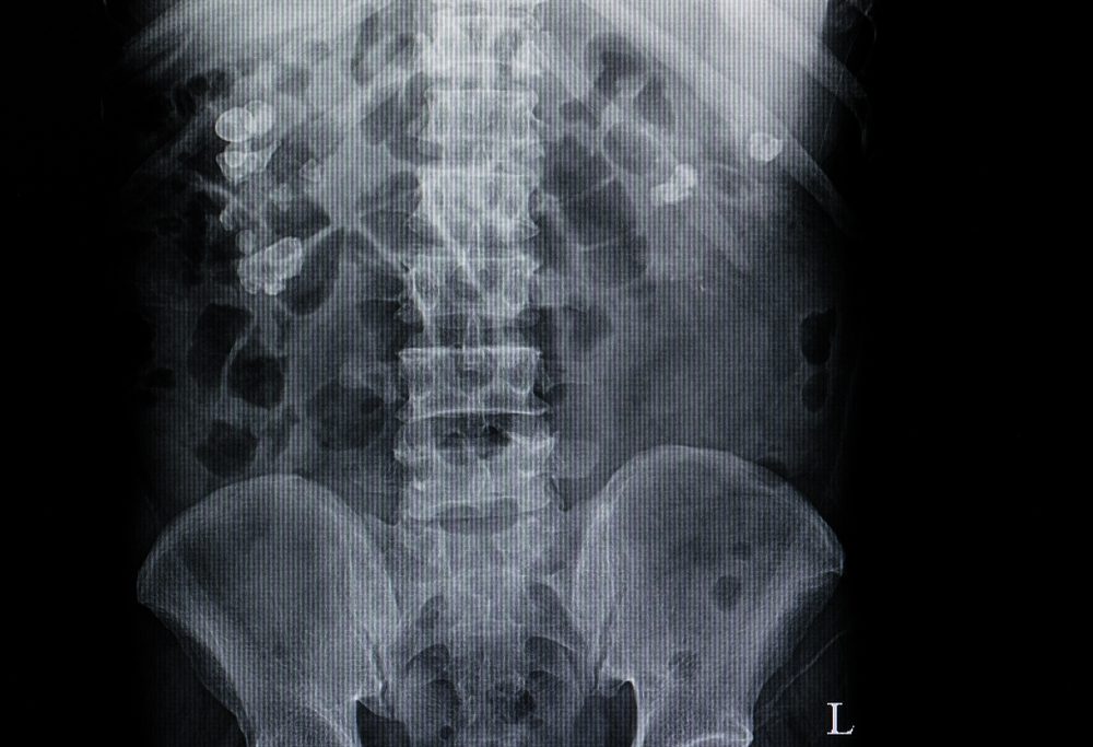 xray film of a patient with multiple stones in both kidneys. Renal calcified calculi. Opacity in abdominal film. Diagnostic investigation. KUB.