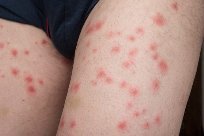 Bed bug bites on a man's arms.
