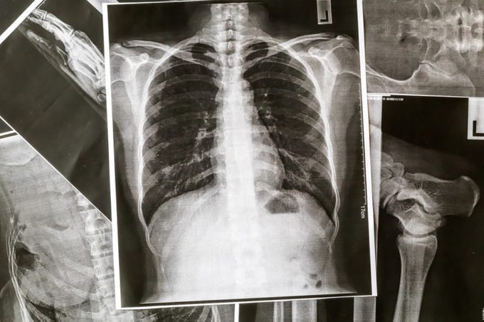 X-Ray Image Of Human Chest for a medical diagnosis.Chest and lungs Xray photo