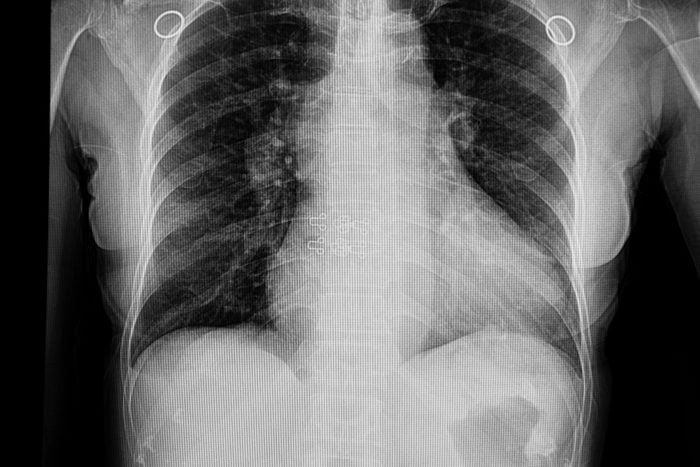 A chest xray film of a patient with cardiomegaly and congestive heart failure.