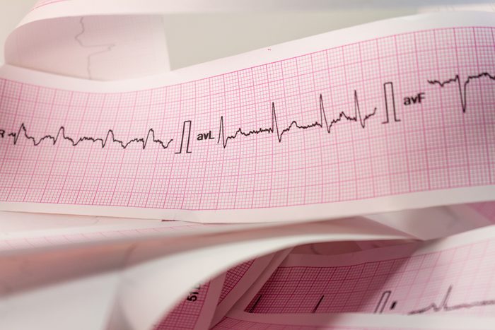 Strip an electrocardiogram. Record of heartbeats.