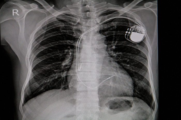 Chest x-ray image of permanent pacemaker implant in body chest.