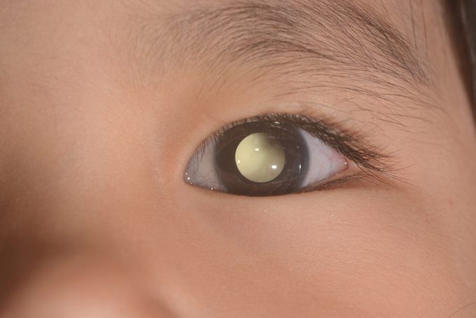 close up of the leukicoria eye