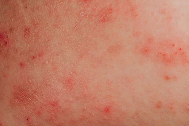 eczema allergy on skin