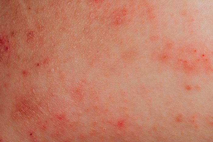 eczema allergy on skin