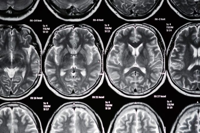 brain scan mri stroke