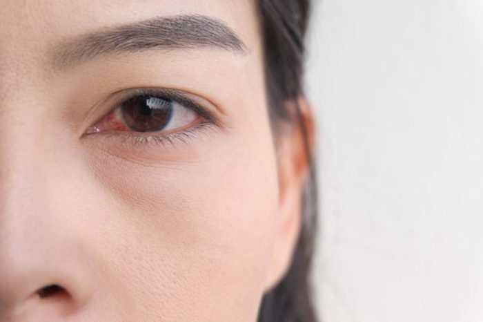 Closeup of a woman with a bloodshot eye.