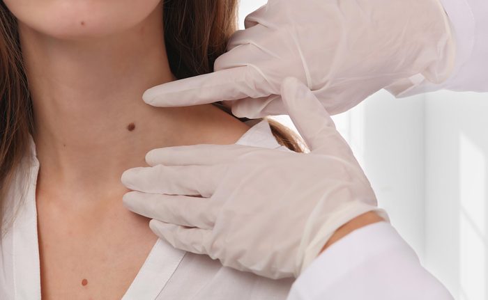 Doctor dermatologist examines birthmark of patient. Checking benign moles. Laser Skin tags removal