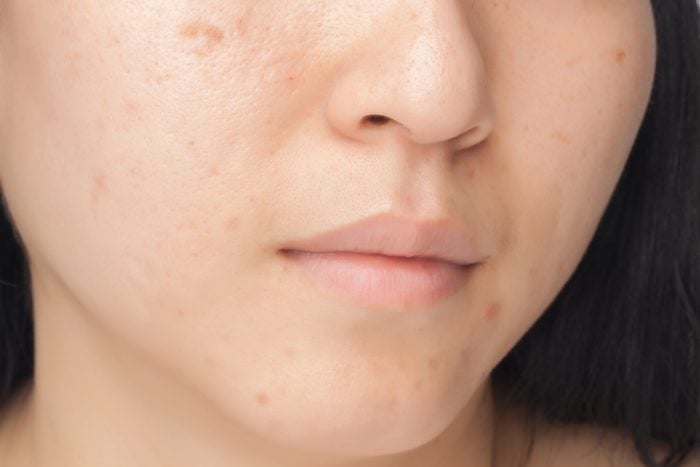 close up of woman's face with spots
