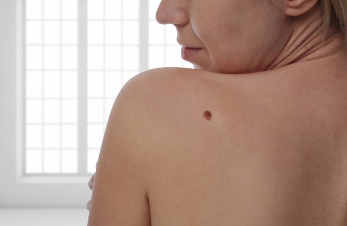 mole on woman's back