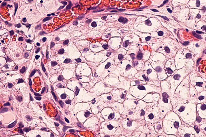 kidney cancer cells microscope
