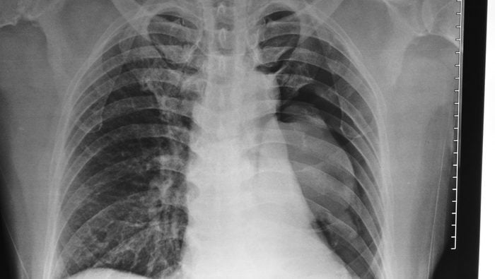 Left Lung Collapse with Pneumothorax and multiple rib fractures.