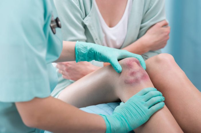 woman hospital leg bruise necrotizing fasciitis