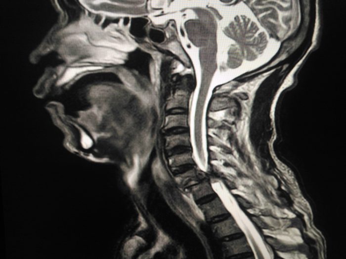 MRI Cervical spine Suspected unilateral interfacetal dislocation at C6-C7 vertebrae,with spinal myelopathy at C6-7 levels,abnormal high signal intensity on T2WI and STIR- along spinal myelopathy