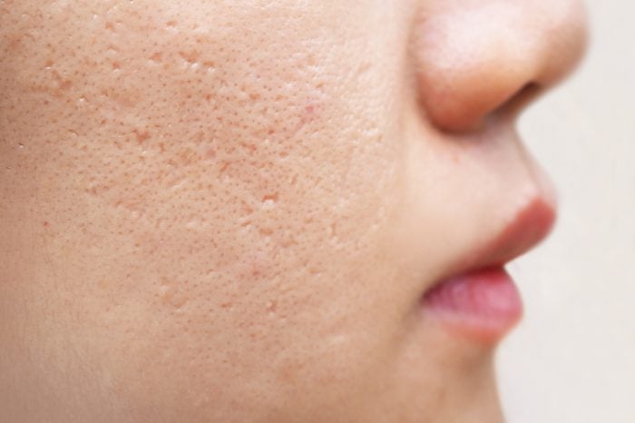 acne scars on woman's cheek