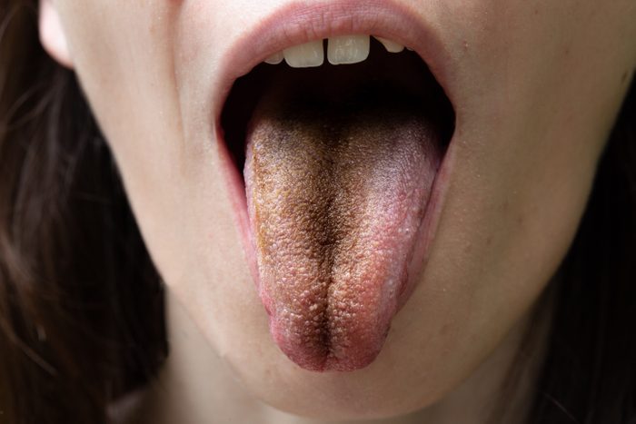 Black tongue, clinical case of lingua villosa