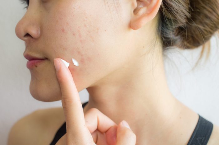 Woman applying acne cream to her face