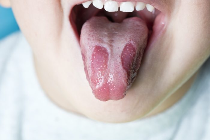 Geographic tongue disease in a young child.