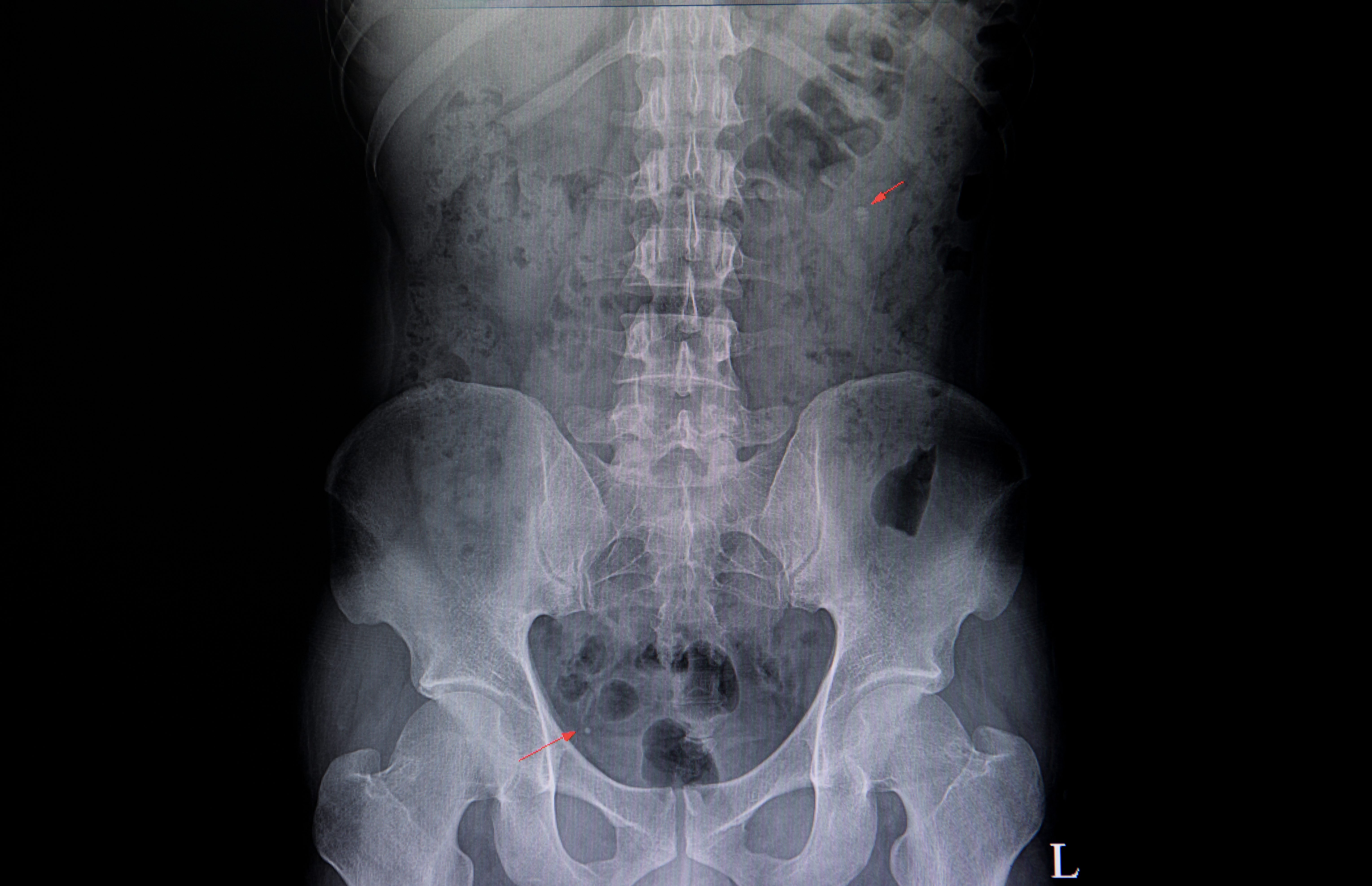 Xray image of a paient showing two ureteric stones.
