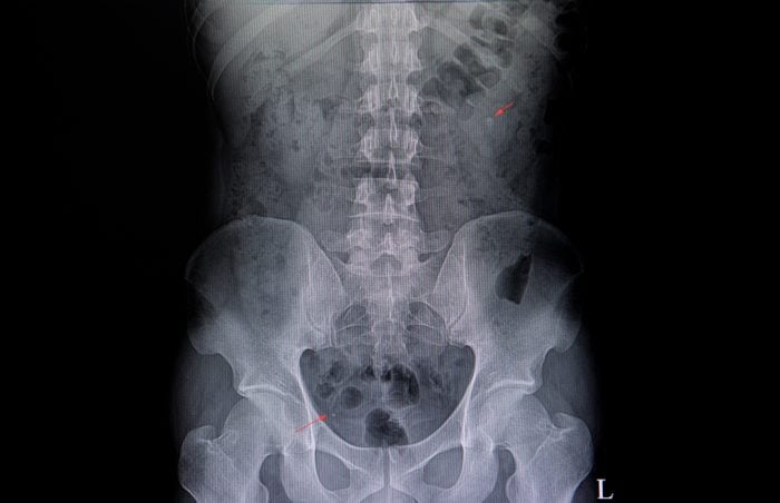 Xray image of a paient showing two ureteric stones.