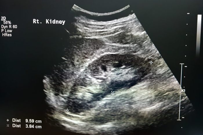 Kidney Ultrasound
